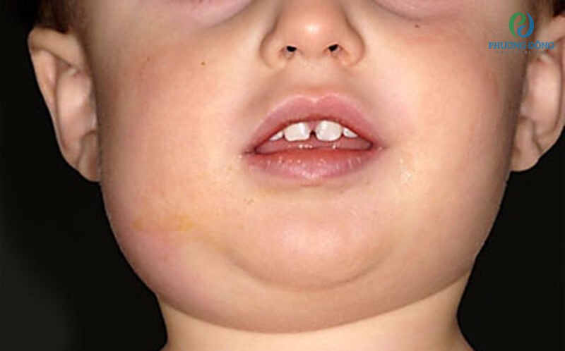 Bệnh quai bị có thể gây ra biến chứng viêm tinh hoàn ở trẻ em
