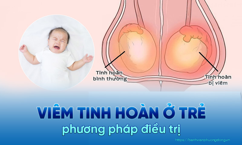 Bệnh viêm tinh hoàn ở trẻ em và phương pháp điều trị