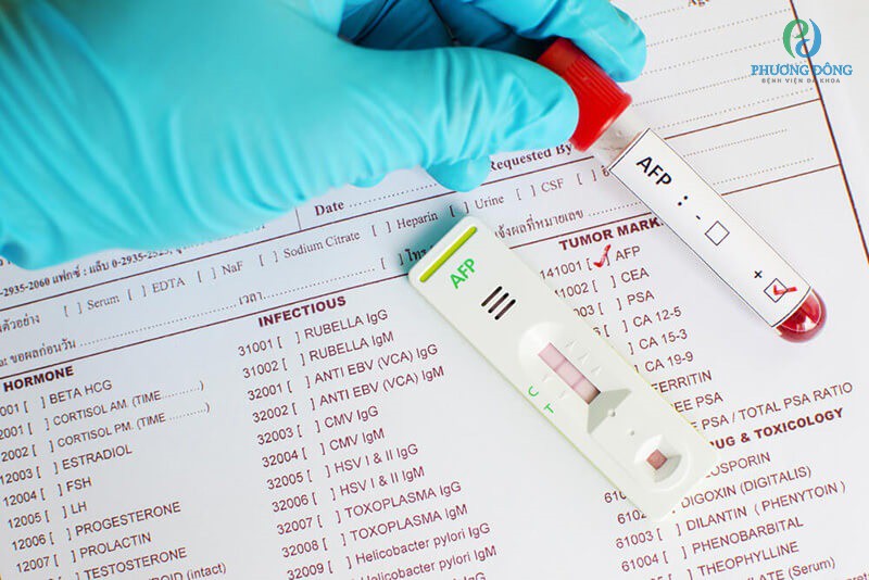 Chẩn đoán bệnh ung thư gan thường ứng dụng xét nghiệm AFP