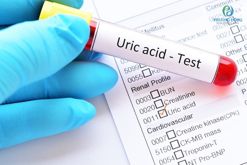 Kiểm tra lượng Acid Uric trong máu là công việc rất quan trọng