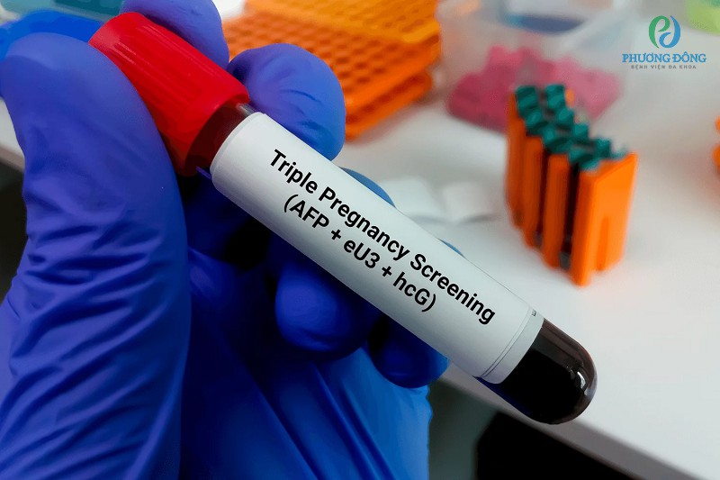 Triple test sử dụng máu để kiểm tra rối loạn, sự tăng giảm của bộ ba chỉ số