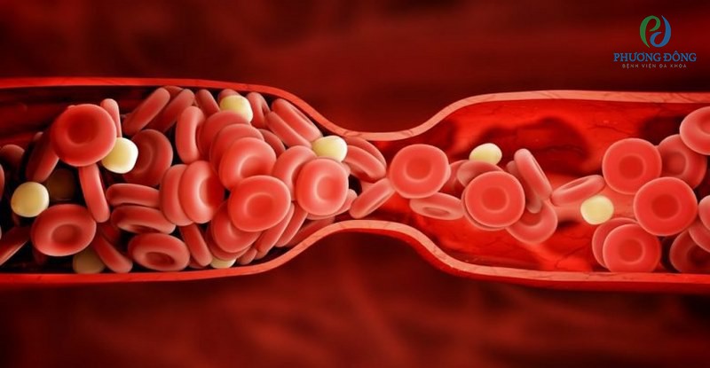 Mạch máu lớn và trung bình xuất hiện các cục máu đông gây tắc động mạch