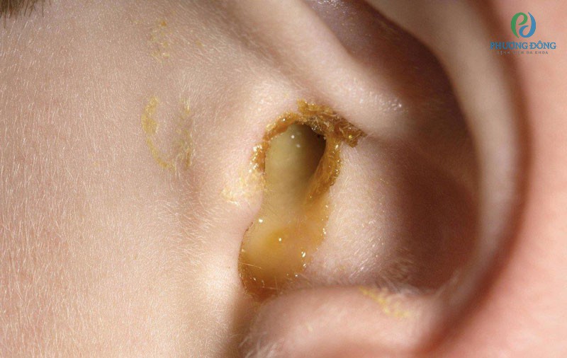 Nhiễm trùng tai giữa khiến ráy tai có mùi hôi và chảy dịch viêm