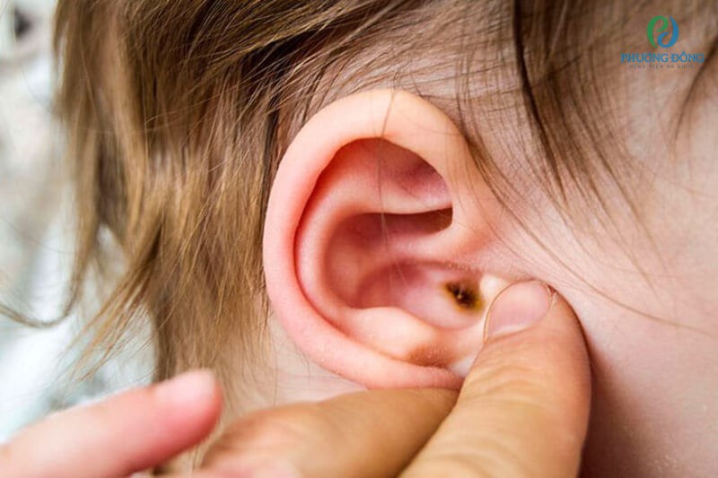Nhiễm trùng tai ngoài cũng có thể gây mùi hôi tai