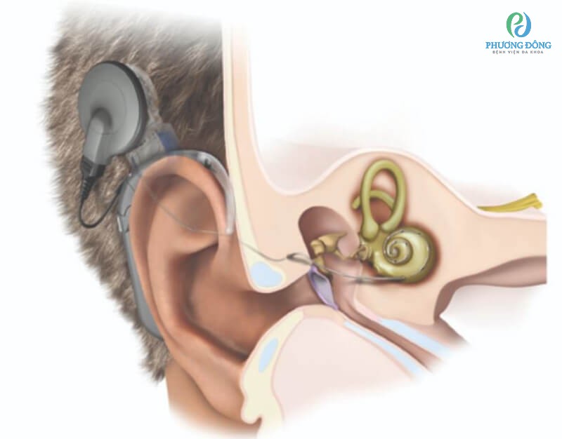 Người bệnh có thể được điều trị bằng cách đeo máy trợ thính