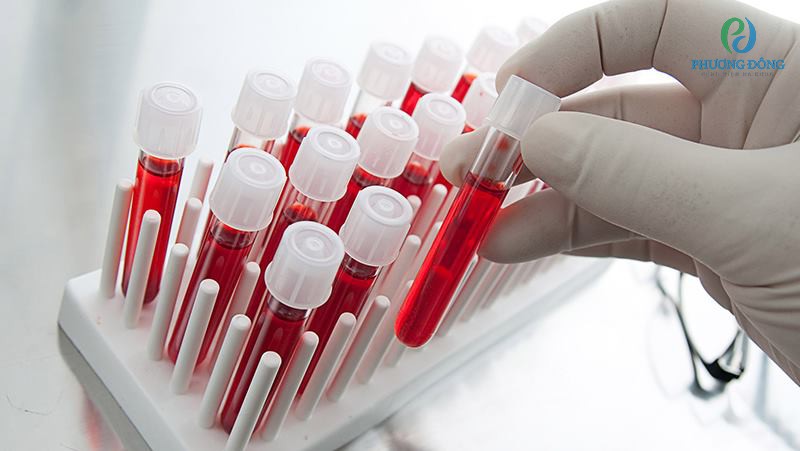 Xét nghiệm máu là phương pháp chuẩn đoán bệnh chuẩn xác