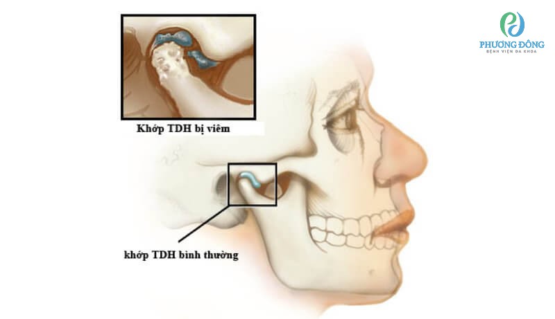 Viêm khớp thái dương hàm dẫn tới rối loạn TMJ