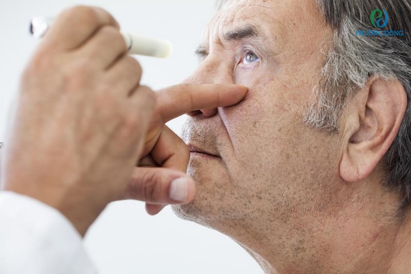 Các bác sĩ nhãn khoa có thể dùng thuốc nhỏ mắt làm giãn đồng tử