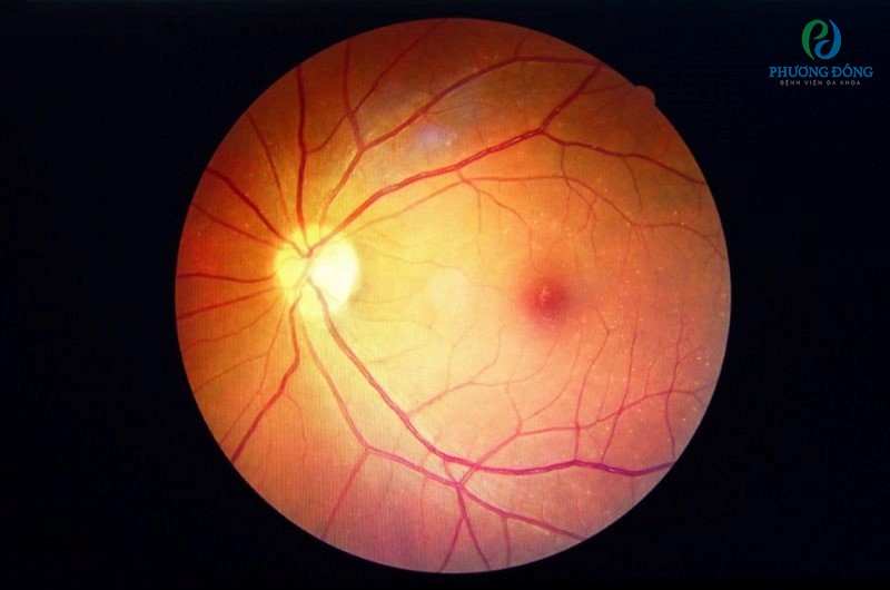 Lỗ hóa điểm vàng là tình trạng bệnh lý đặc biệt tại hoàng điểm của mắt