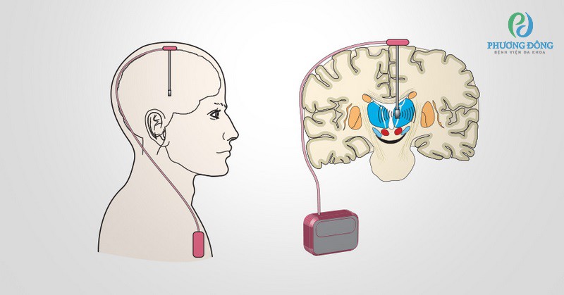 Kỹ thuật kích thích não sâu được xem là phương pháp mới nhất và hiệu quả