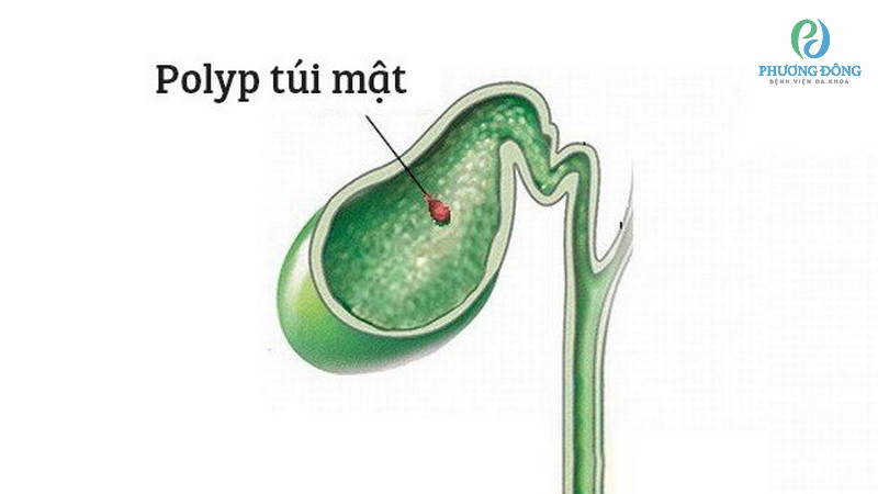 Polyp là tình trạng xuất hiện của những mô bất thường phát triển 