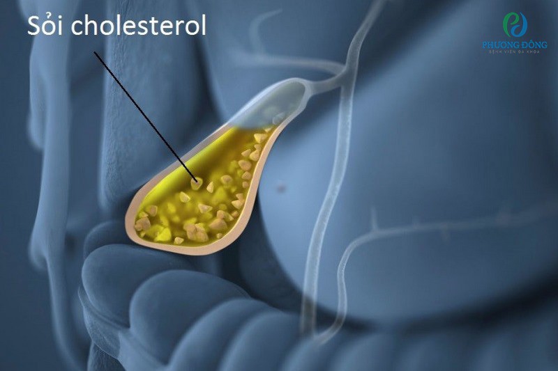 Sỏi cholesterol là loại sỏi chiếm đến 80% các loại sỏi mật
