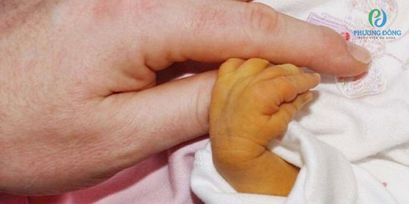 Phân của trẻ sơ sinh có màu nhạt là biểu hiện của bệnh vàng da