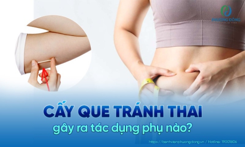 [Giải đáp] Cấy que tránh thai tác dụng phụ như thế nào?