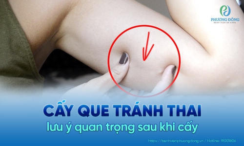 Những lưu ý sau khi cấy que tránh thai chị em cần biết