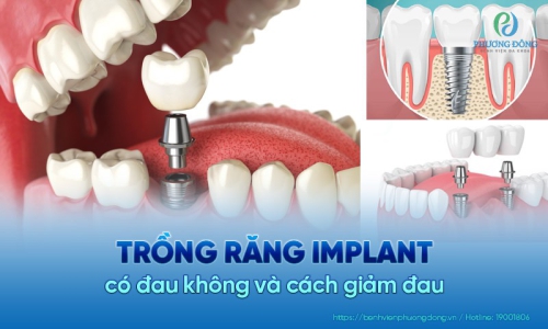 [Phương Đông giải đáp] Trồng răng implant có đau không? 