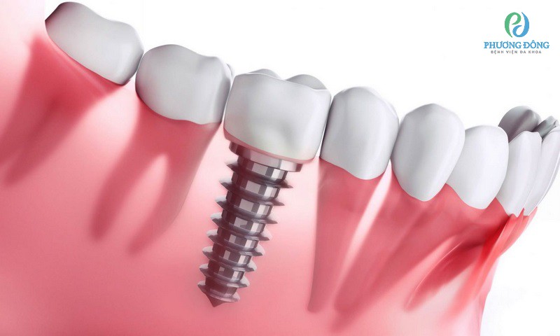 Cấy răng Implant ngăn chặn tiêu xương và quá trình vệ sinh đơn giản  