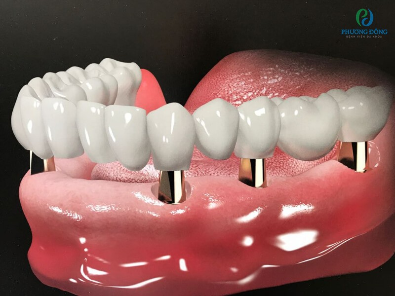 Trồng răng implant đảm bảo hàm răng chắc chắn