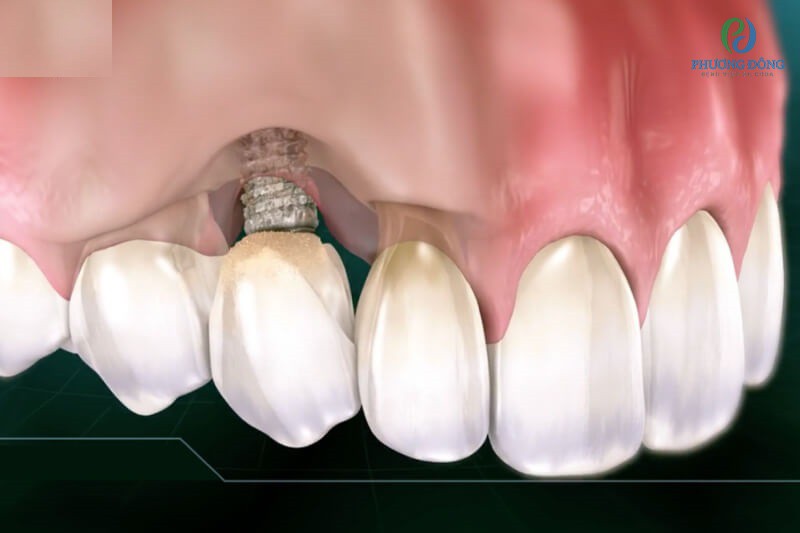Trồng răng không đúng vị trí có thể dẫn tới lực nhai yếu