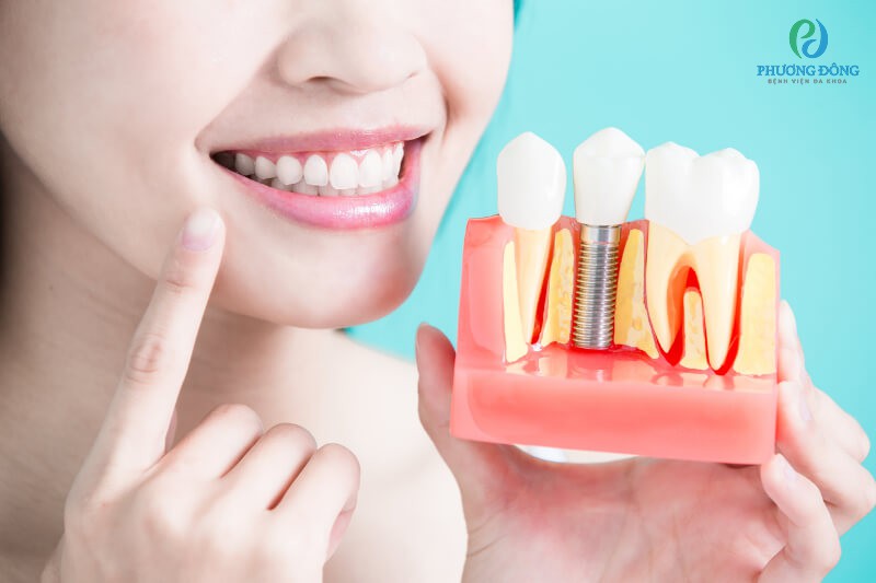 Phải tìm hiểu kỹ về phương pháp trồng răng trước khi thực hiện