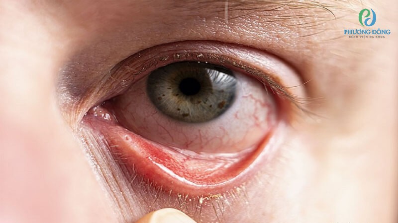 Viêm kết mạc dị ứng là chứng bệnh về mắt xuất hiện rất phổ biến