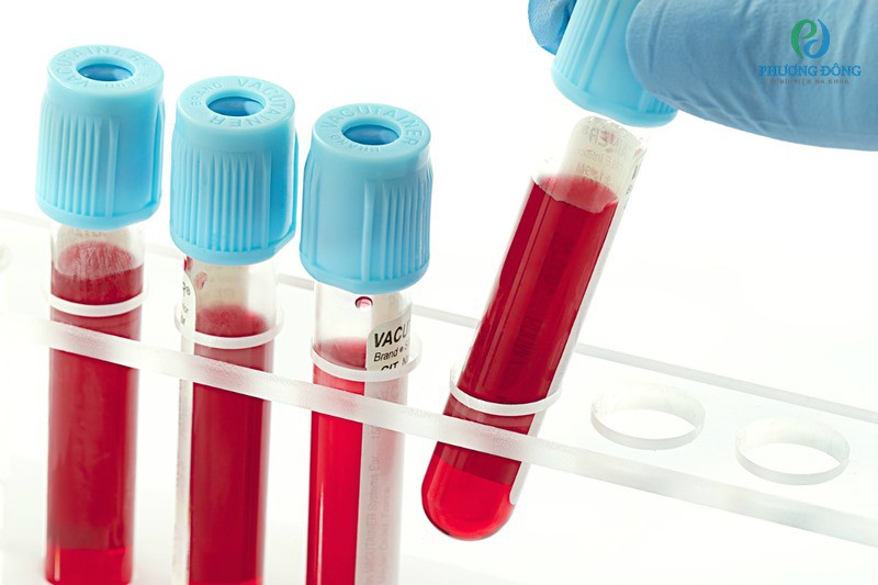 Xét nghiệm máu giúp phát hiện tình trạng viêm kết mạc dị ứng