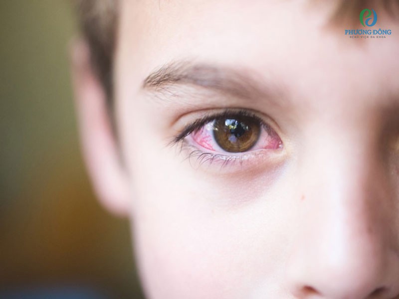 Viêm kết mạc mắt trẻ em thường xảy ra vào thời điểm chuyển giao mùa