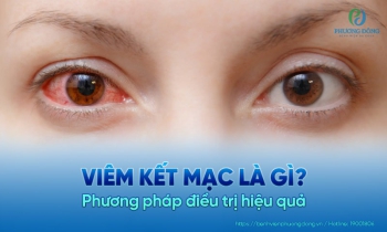 Tìm hiểu viêm kết mạc là gì và phương pháp điều trị