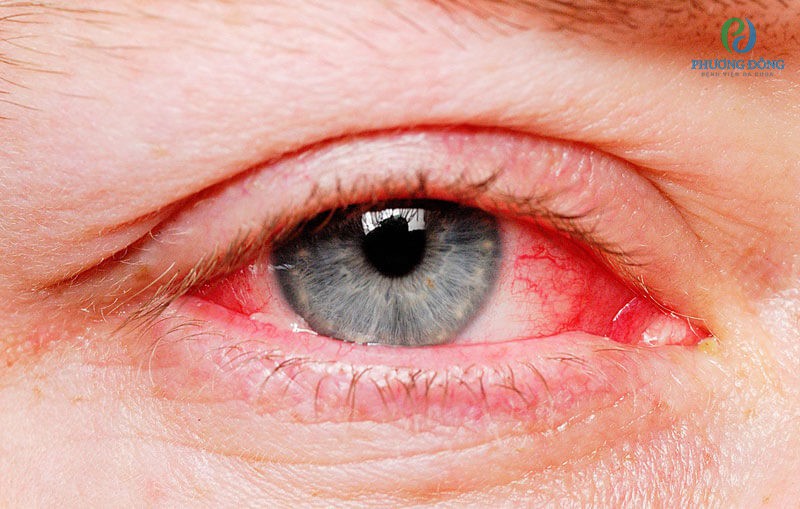 Viêm kết mạc là bệnh lý về mắt rất phổ biến hiện nay