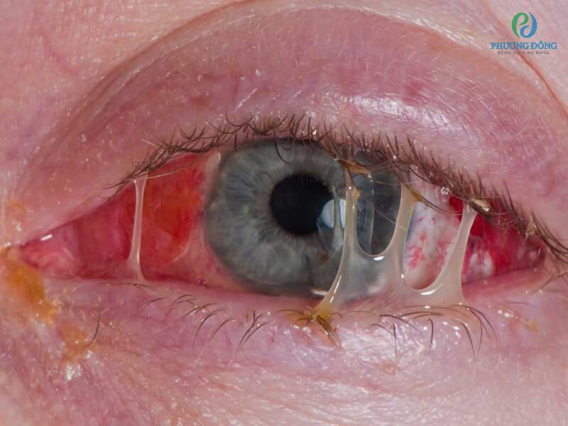 Người bệnh bị đau mắt đỏ do vi khuẩn xuất hiện gỉ mắt vàng
