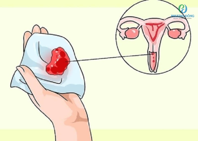 Đặt vòng ngừa thai có thể gây viêm nhiễm âm đạo