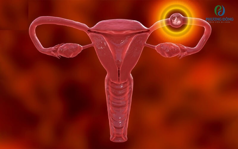 Đặt vòng tránh thai tồn tại một số nhược điểm nhất định
