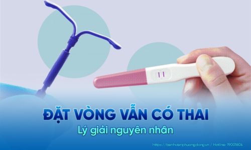Tìm hiểu về về những nguyên nhân đặt vòng vẫn có thai