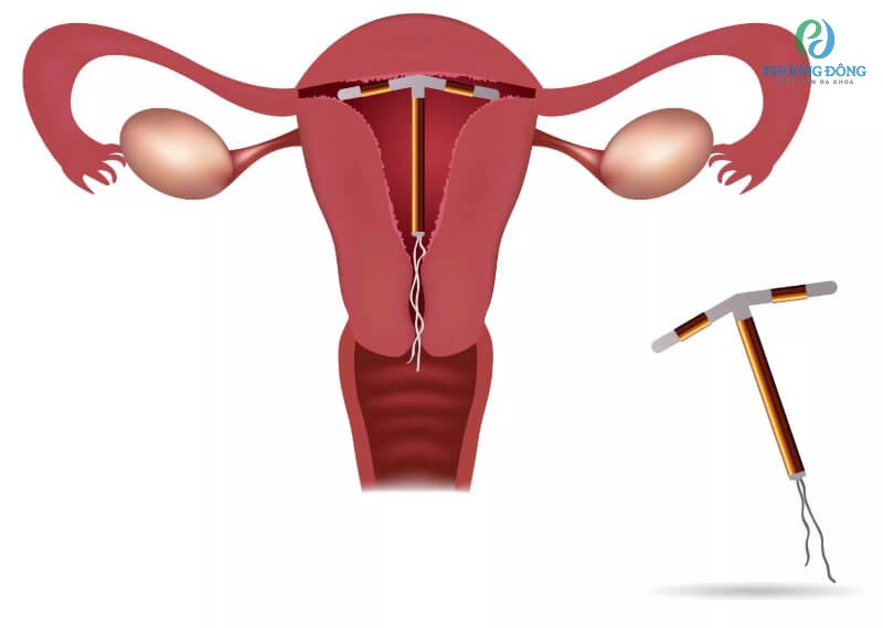 Vòng tránh thai là một trong những dụng cụ kích thước nhỏ có chứa đồng
