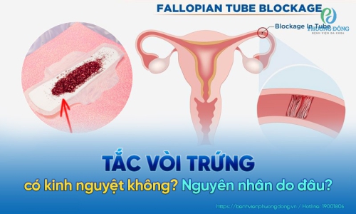 Tắc vòi trứng có kinh nguyệt không? Chị em cần lưu ý gì?