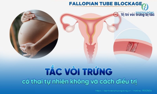 Tắc vòi trứng có thai tự nhiên được không? Cách chữa trị?