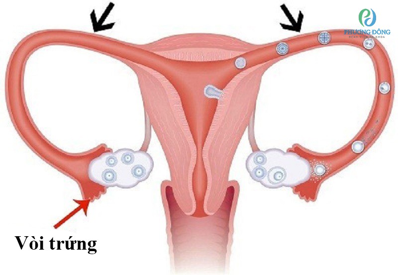 tắc vòi trứng ảnh hưởng đến việc thụ thai