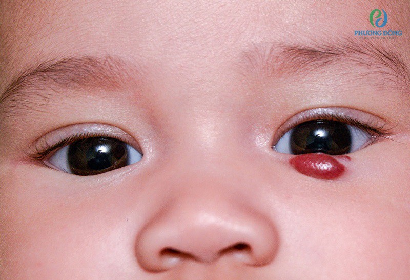 Các cục u máu xuất hiện trên mặt của trẻ