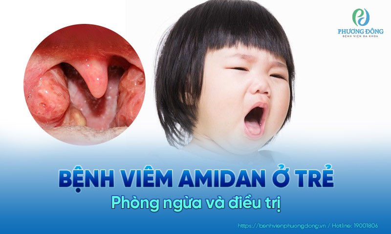 Viêm amidan ở trẻ em và biện pháp phòng tránh bệnh đúng cách