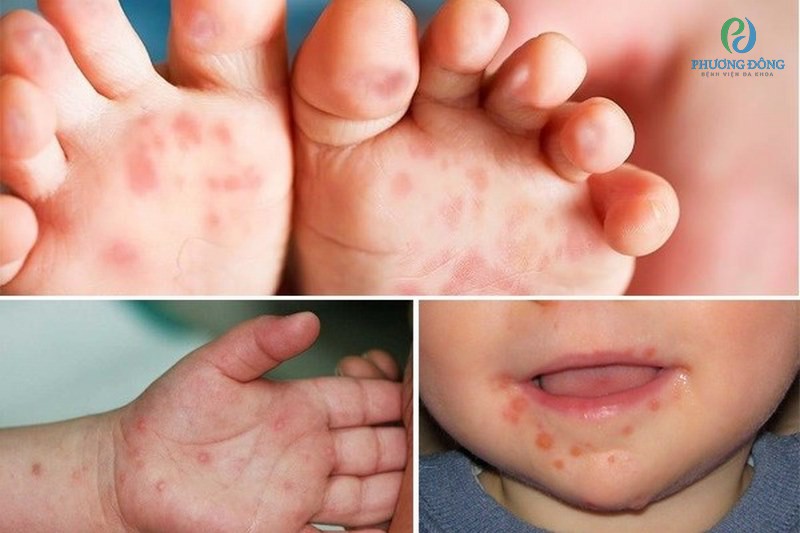Trẻ bị tay chân miệng dẫn đến tình trạng viêm loét miệng họng