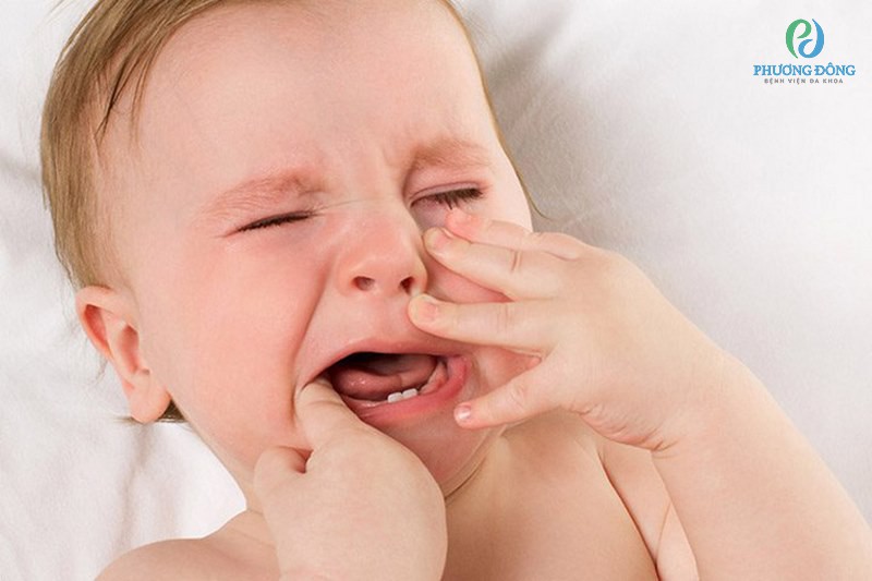 Trẻ nhỏ có nguy cơ mắc bệnh viêm loét miệng họng cao