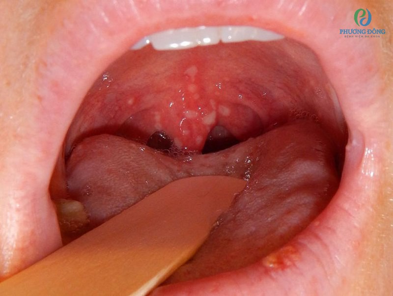 Các biểu hiện và triệu chứng của viêm loét miệng họng ở trẻ em là gì?