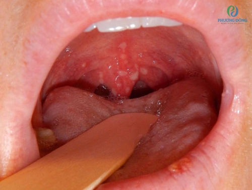 Khi bé bị viêm loét miệng họng sốt cao cha mẹ nên làm gì?