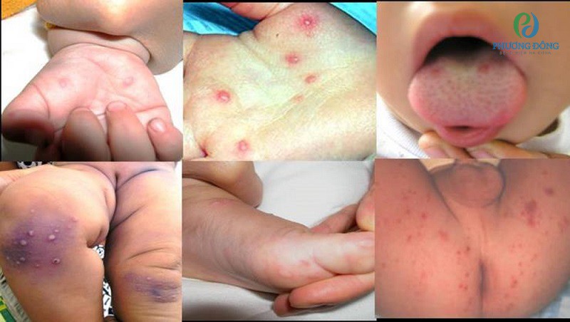 Trẻ mắc tay chân miệng cũng xuất hiện các nốt viêm loét trong miệng