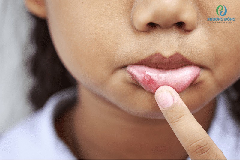 Nguyên nhân loét miệng ở trẻ và cách chăm sóc hiệu quả