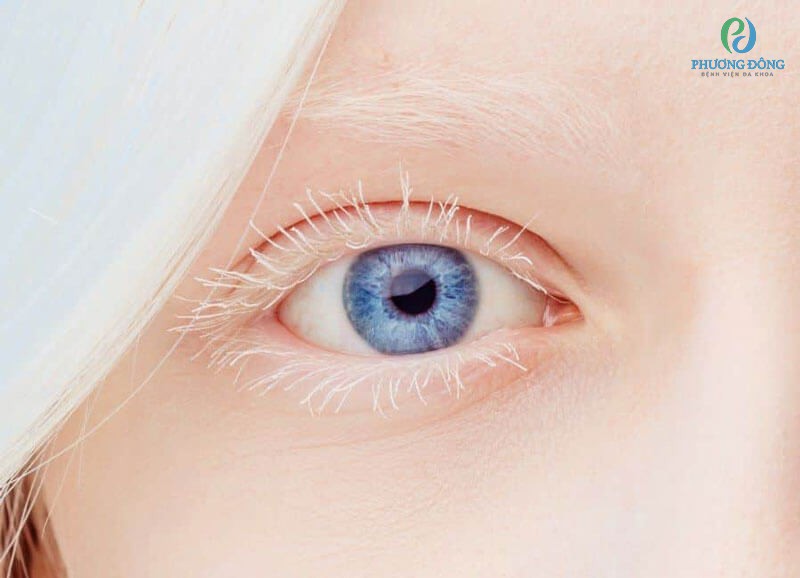 Đôi mắt của người bị bạch tạng thường có màu nhạt và dễ gặp vấn đề về thị lực