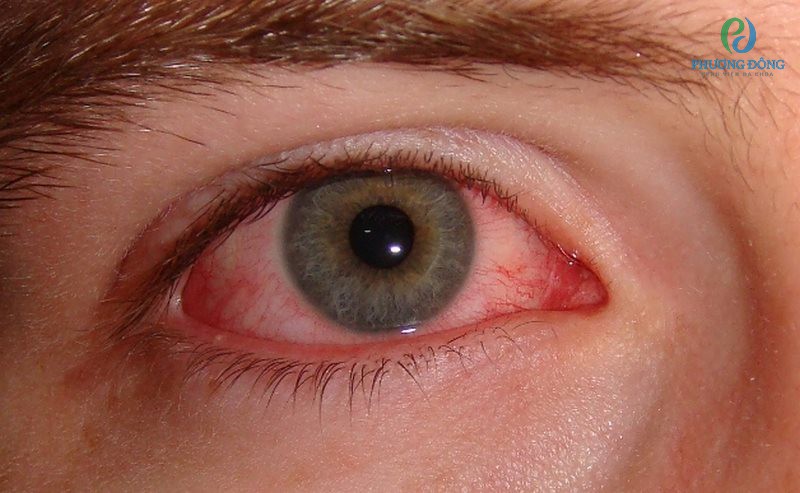 Dị ứng ở mắt còn có tên gọi khác là viêm kết mạc dị ứng