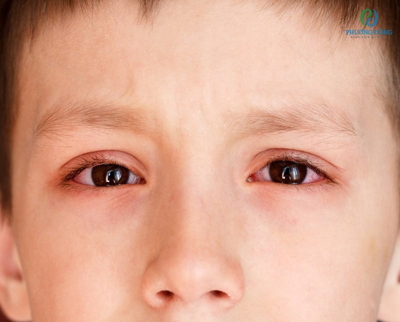 Trẻ em là đối tượng dễ bị dị ứng ở mắt