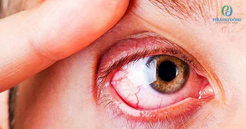 Dị ứng ở mắt có thể gây nên viêm trong nhãn cầu