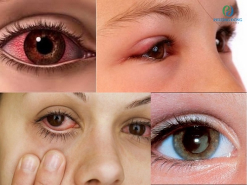 Dị ứng mắt là gì? Nguyên nhân gây bệnh và cách điều trị hiệu quả